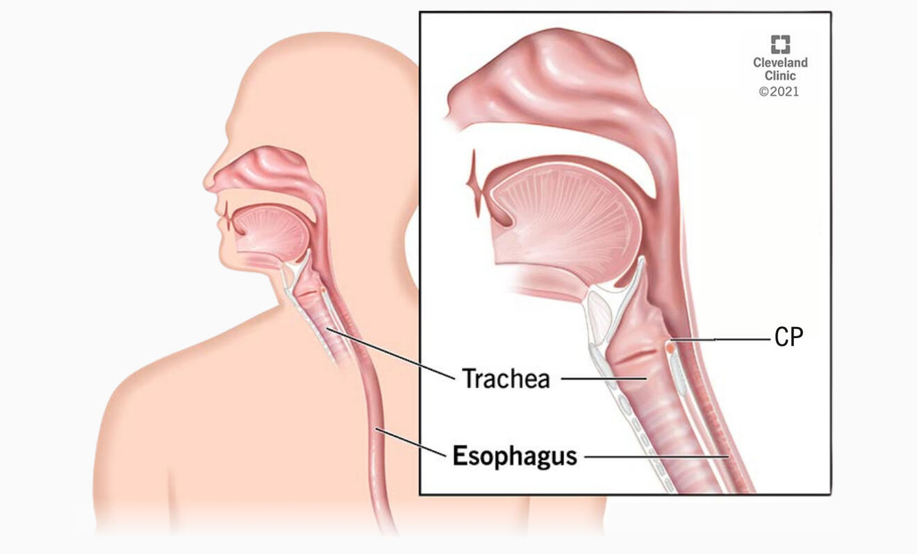 Graphic of head and neck anatomy, labeling the trachea, esophagus, and CP muscle.